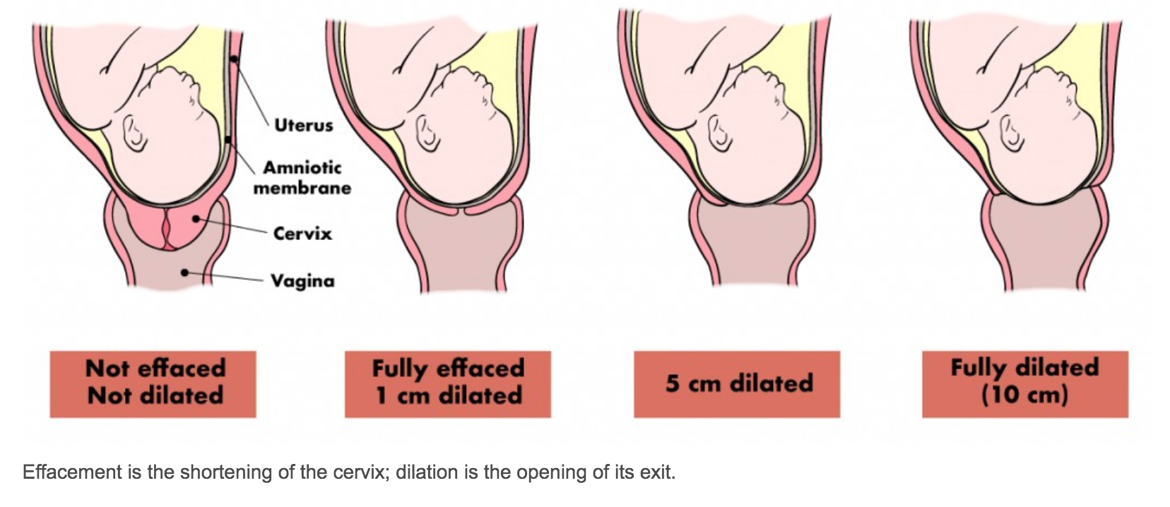 dilated cervix labor